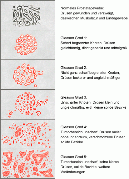 prostatakarzinom stadien gleason