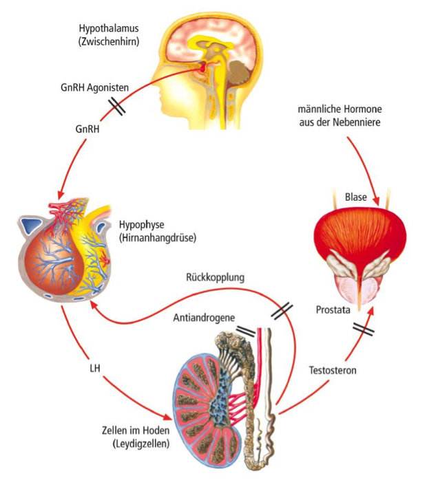 prostatakarzinom therapie hormontherapie