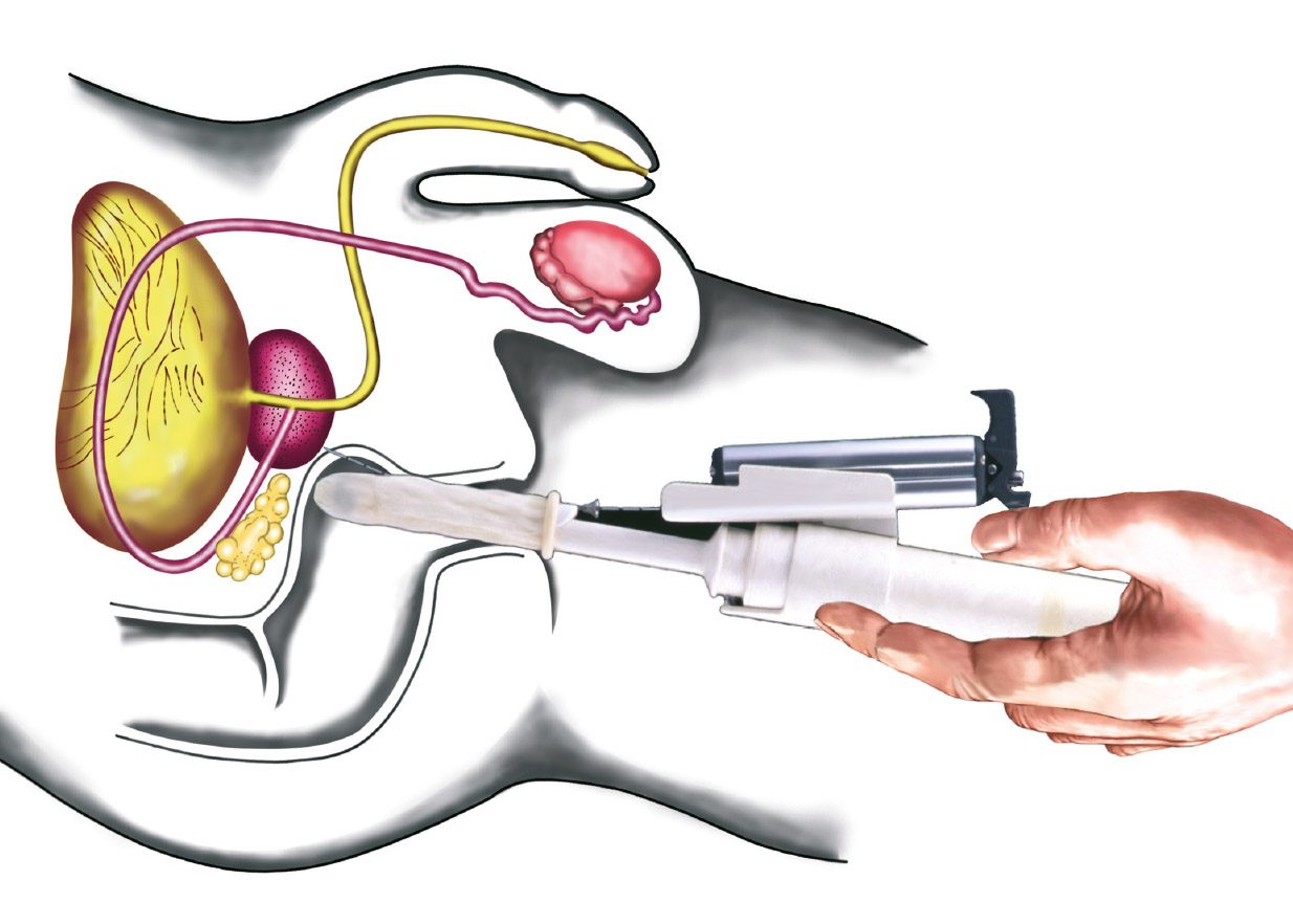 biopsie prostata)