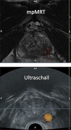 Fusionsbiopsie der Prostata