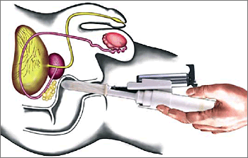 Abbildung 1: Transrektaler Ultraschall (TRUS). Der Untersucher führt die Sonde (hier mit aufgesetztem Biopsieapparat), ihre Spitze liegt unter der Prostata im Rektum (Mastdarm).
