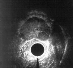 stanzbiopsieabb-5.jpg