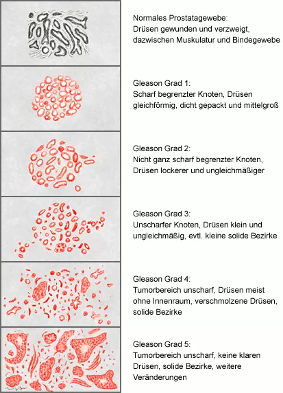 Die fünf Wachstumsmuster des Adenokarzinoms der Prostata